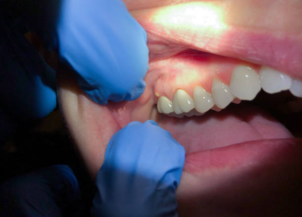 Best Knocked-Out Tooth Emergency  in North Lynnwood, WA